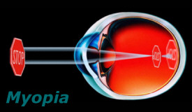 a látás korrekciója rendszerrel látásjavító szemüveg velemeny